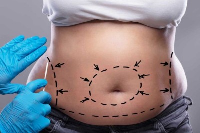 Tummy Tuck Dubai: Recovery Timeline and Healing Tips