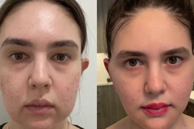 Best Buccal fat removal Surgeon in Dubai vs Abroad