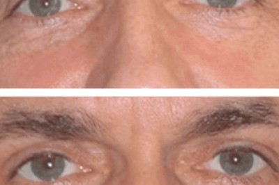 Can Fillers Replace Surgery? Best Eye bag removal Surgeon in dubai Opinion