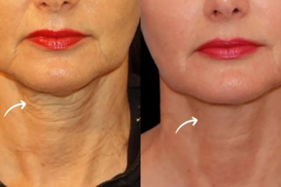 Patient Experience with Sculptra in Dubai
