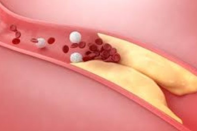 How Doctors Diagnose High Cholesterolemia Dubai