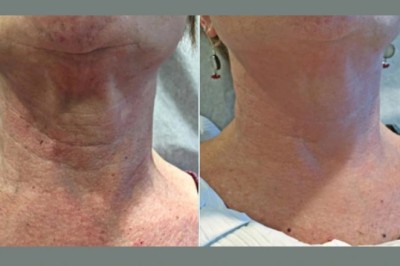 Skin Tightening Treatments in Dubai: What to Know Before Getting Skin Tightening