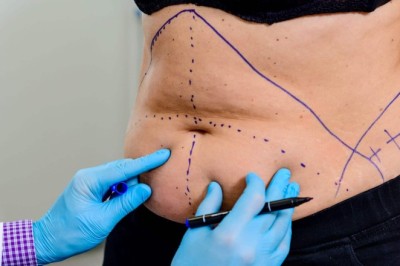 Mommy Makeover for a Refreshed and Confident Appearance