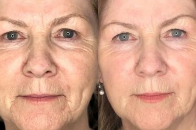 How Does the Best Aesthetic Clinic in Dubai Ensure Profhilo Safety?