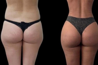 Is J-Plasma Treatment in Dubai Worth It? Complete Expert Guide