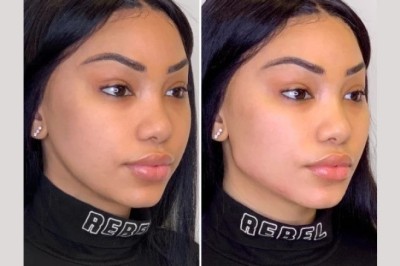 Thread lift in Dubai Using Minimally Invasive Aesthetic Procedures