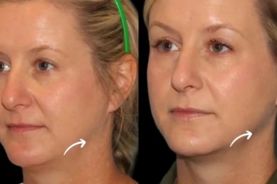 Best Plastic Surgeons in Dubai Use Sculptra for Elegant Results