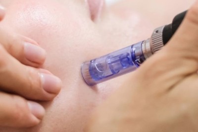 How Microneedling in Manchester Reduces Large Pores Naturally