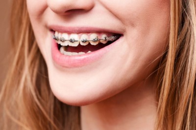 Why Do Kids Need Dental Braces in Dubai?