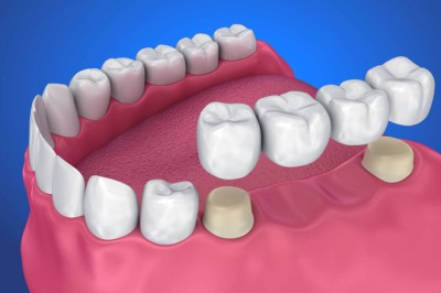 What Materials Are Used in Dental Crowns and Bridges?