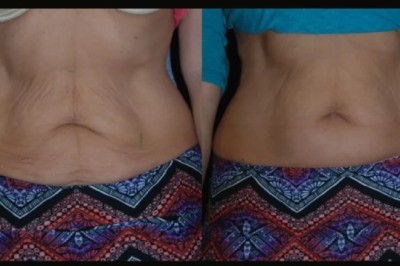 Best Aesthetic Clinic in Dubai for Professional Skin Tightening