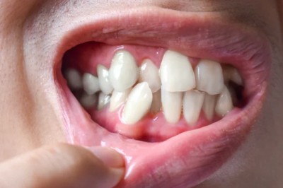What Are Common Methods of Crooked Teeth Treatment in Dubai?
