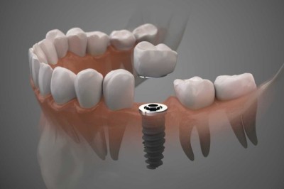 Dental Implants in Dubai: Complete Guide for 2026