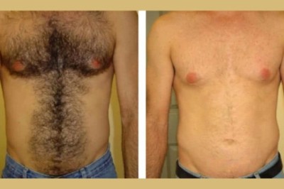 Electrolysis Laser Hair Removal in Dubai for All Skin Types