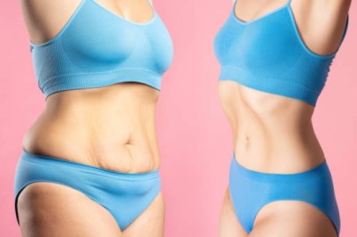 Liposuction Trends and What They Mean for Body Sculpting