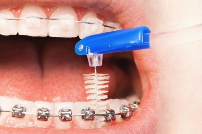 Ceramic Braces Advantages in Dubai