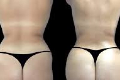 Combining liposuction with Butt Fat transfer in Dubai