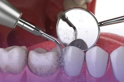 Scaling and Polishing in Dubai: Complete Guide