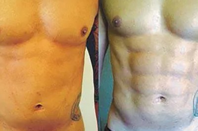 Vaser Liposuction for Men in Dubai