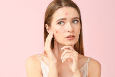 Acne Treatment in Dubai: Hormonal Acne and How to Manage It