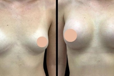 Breast Augmentation Surgery in Dubai: Celebrity Trends and Popular Choices