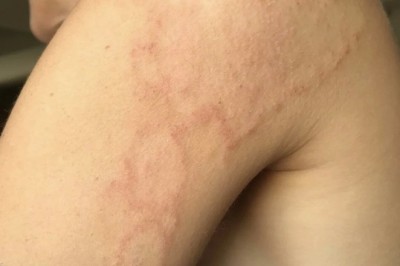 How to Recognize and Treat Fungal Skin Infections