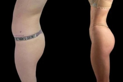 J-Plasma Treatments in Dubai: Improve Skin Elasticity Effectively