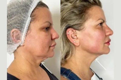 Best Doctors in dubai for Endolift Under-Eye Tightening Solutions