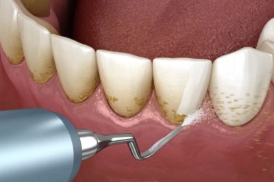 What Are the Benefits of Teeth Cleaning in Dubai?