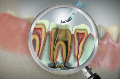 Root Canal Specialist Dubai: Expert Care Guide