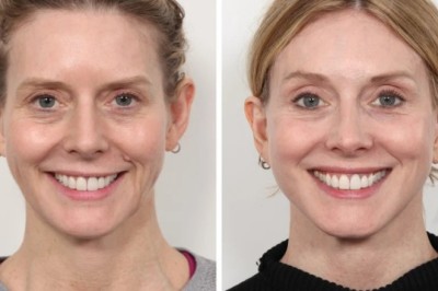 Thread Lift for Quick Results by Best Doctors in Dubai