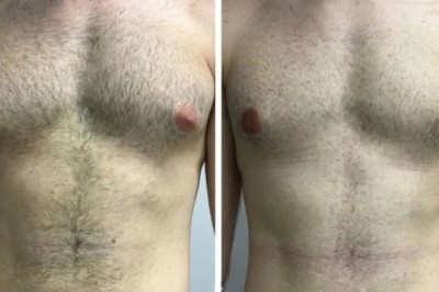 Why Personalized Treatment Matters in Gynecomastia Surgery in Dubai