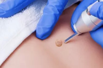 Why Choose Laser Warts Removal Treatment in Dubai for Clear Skin