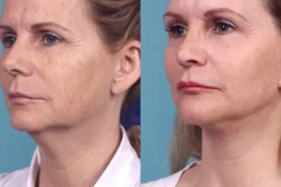 Chemical Peel Treatment in dubai after sun exposure