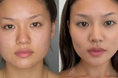 How Safe Is Buccal fat removal in Dubai? Expert Insights