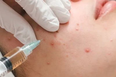 Say Goodbye to Breakouts with Acne Treatment in Dubai