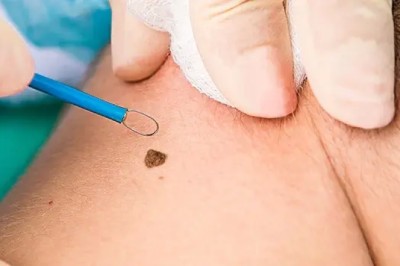 Clear Skin Benefits of Laser Warts Removal Treatment in Dubai