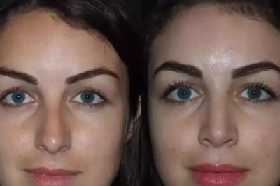Rhinoplasty in Dubai: Achieving Balanced Facial Features