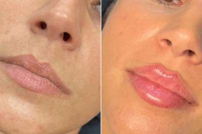 Juvederm for Women Over 40 at the Best Aesthetic Clinics in dubai