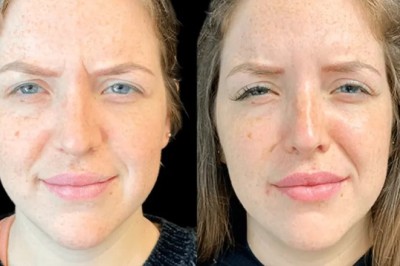 Botox in Dubai for Busy Professionals: Quick Beauty Fix