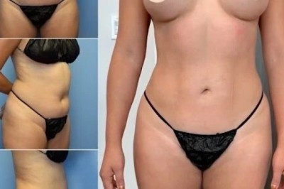 Best Body Contouring Surgeons in dubai for Safe and Effective Contouring