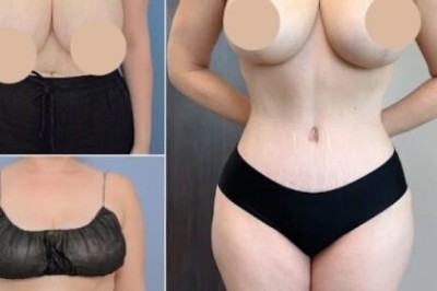 Best Tummy Tuck Surgeons in Dubai for Tailored Cosmetic Solutions