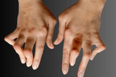 Understanding Hand Deformities Treatment and Recovery Options