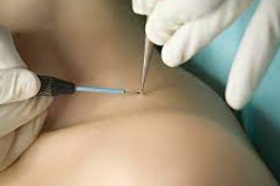 Dermatology Guide to Laser Warts Removal Treatment in Dubai