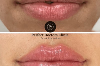Juvederm for Soft Tissue Augmentation by the Best Doctors in dubai