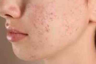 The Ultimate Guide to Treating Adult Acne