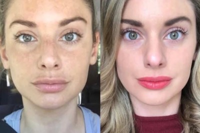 Best Doctors in dubai: Radiofrequency (RF) Microneedling for Pigmentation Issues