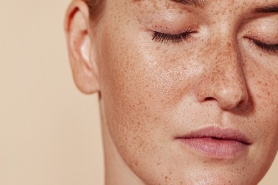 Pigmentation Treatment in Dubai: Seasonal Skincare Tips for Better Results