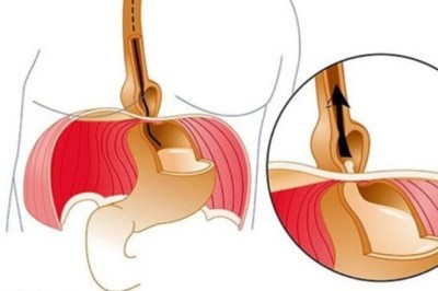Gallbladder Stones: Symptoms, Causes, and Advanced Treatment
