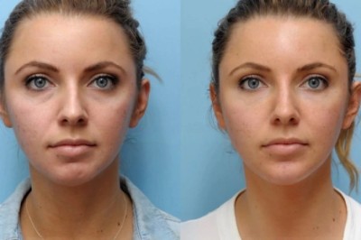 Thread Lift in Dubai For Enhanced Jawline Definition